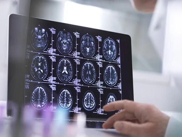 Not Always Alzheimer's: What LATE Dementia Teaches Us About the Aging Brain